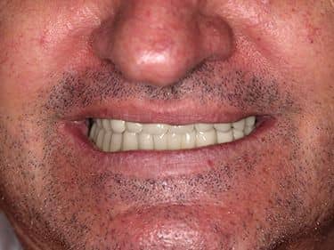 Punți Dentare Metalo-ceramice Fixe cu protezare mixtă