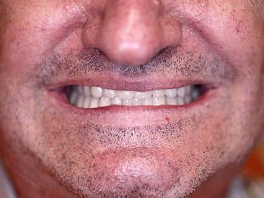 Punți Dentare Metalo-ceramice Fixe cu protezare mixtă