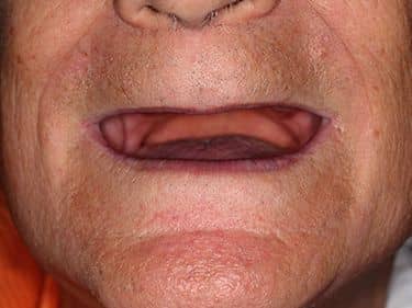 Edentație totală superioară și inferioară