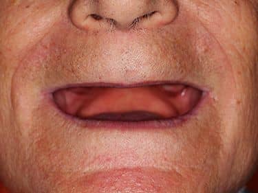 Edentație totală superioară și inferioară