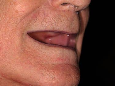 Edentație totală superioară și inferioară