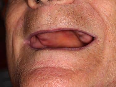 Edentație totală superioară și inferioară