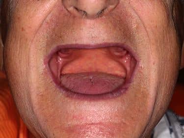 Edentație totală superioară și inferioară