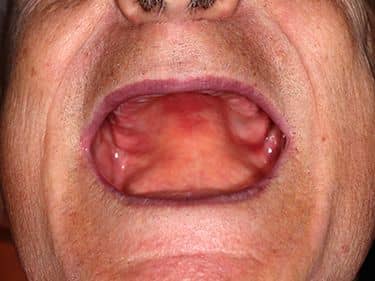 Edentație totală superioară și inferioară