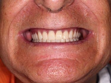 Proteze Dentare Totale