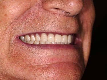 Proteze Dentare Totale