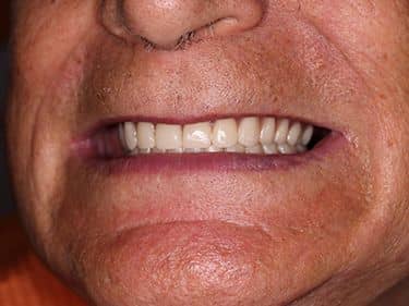 Proteze Dentare Totale