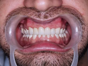 Coroane Dentare din Ceramică pe oxid de Zirconiu