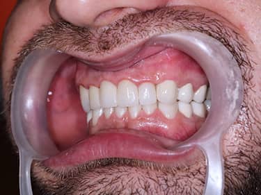 Coroane Dentare din Ceramică pe oxid de Zirconiu