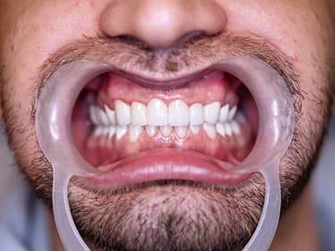 Coroane Dentare din Ceramică pe oxid de Zirconiu