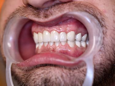 Coroane Dentare din Ceramică pe oxid de Zirconiu