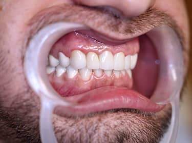 Coroane Dentare din Ceramică pe oxid de Zirconiu