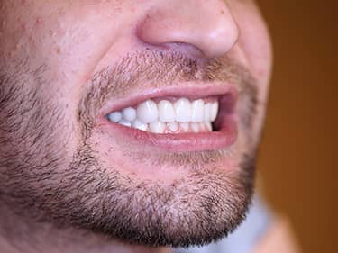 Coroane Dentare din Ceramică pe oxid de Zirconiu