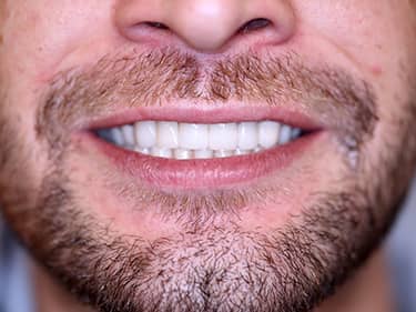 coroane dentare din zirconiu in Cabinet Stomatologic Vatra Luminoasa