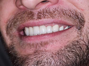 Coroane Dentare din Ceramică pe oxid de Zirconiu