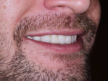 Coroane Dentare din Ceramică pe oxid de Zirconiu