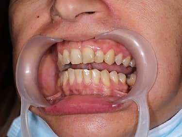 Dinți frontali închiși la culoare