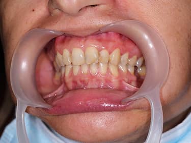 Dinți frontali închiși la culoare