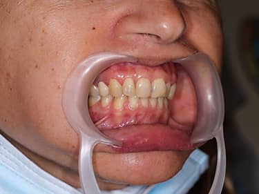 Dinți frontali închiși la culoare