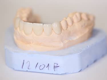 Fațete Dentare ceramice e-Max