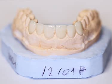 Fațete Dentare ceramice e-Max