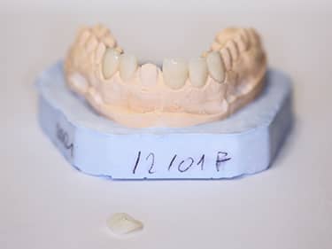 Fațete Dentare ceramice e-Max