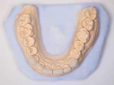 Fațete Dentare ceramice e-Max