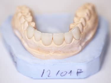 Fațete Dentare ceramice e-Max