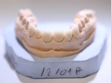 Fațete Dentare ceramice e-Max