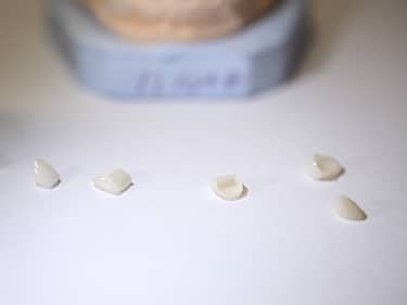 Fațete Dentare ceramice e-Max