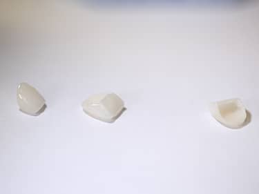 Fațete Dentare ceramice e-Max