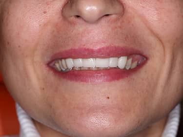 Fațete Dentare ceramice e-Max