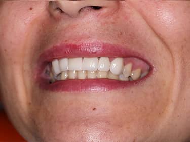 Fațete Dentare ceramice e-Max