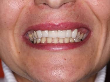 Fațete Dentare ceramice e-Max