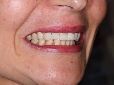 Fațete Dentare ceramice e-Max