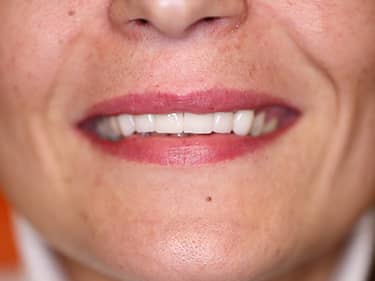 fatete dentare ceramice e-Max la Clinica Stomatologica Sector 2