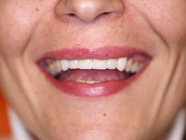 Fațete Dentare ceramice e-Max