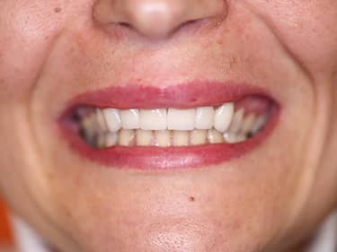 Fațete Dentare ceramice e-Max