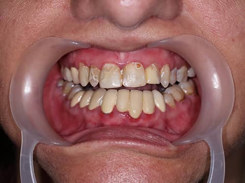 Dinți închiși la culoare