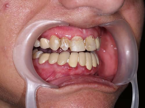 Dinți închiși la culoare