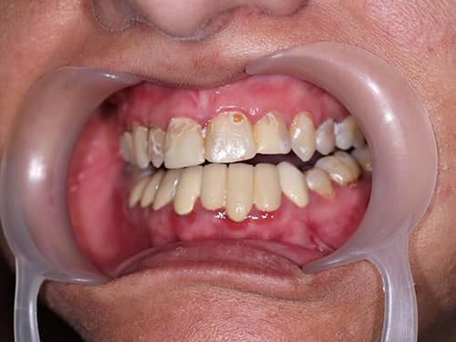 Dinți închiși la culoare