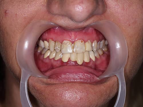 Dinți închiși la culoare