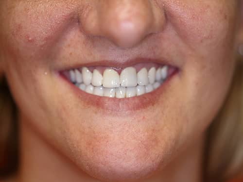 Punți și Coroane Dentare fixe metalo-ceramice