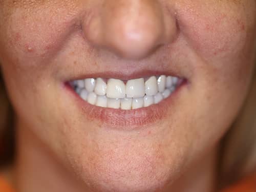 Punți și Coroane Dentare fixe metalo-ceramice