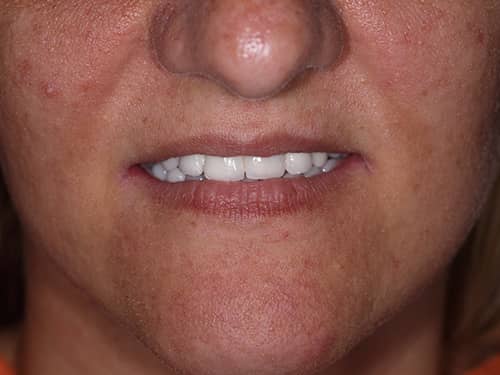 Punți și Coroane Dentare fixe metalo-ceramice