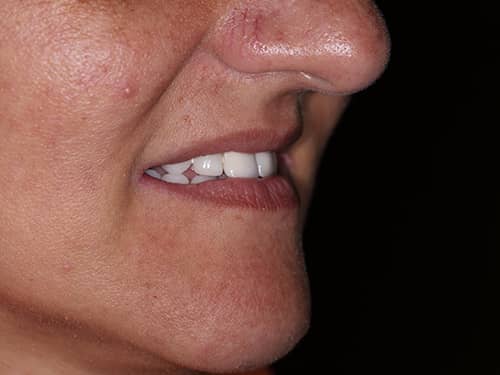 Punți și Coroane Dentare fixe metalo-ceramice