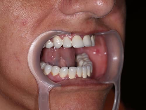 Punți și Coroane Dentare fixe metalo-ceramice