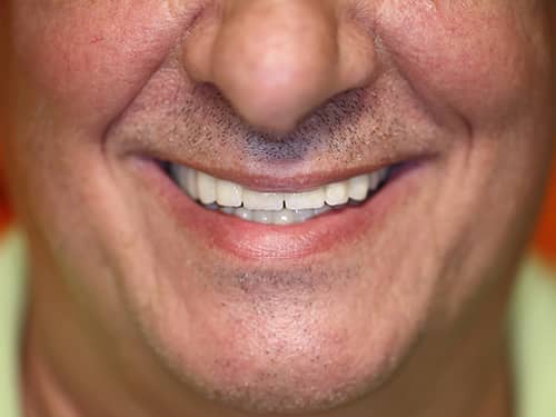 lucrari protetice din portelan in Cabinet Dentar Mihai Bravu