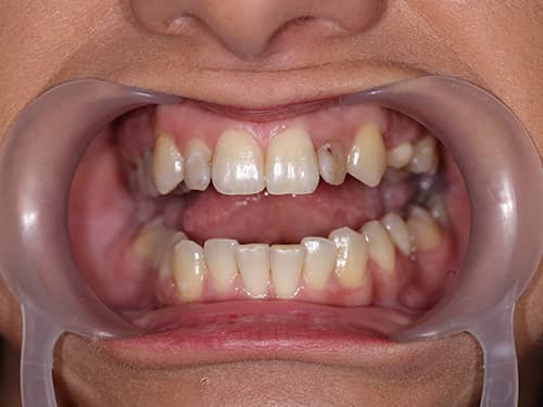 Incisivi laterali închiși la culoare