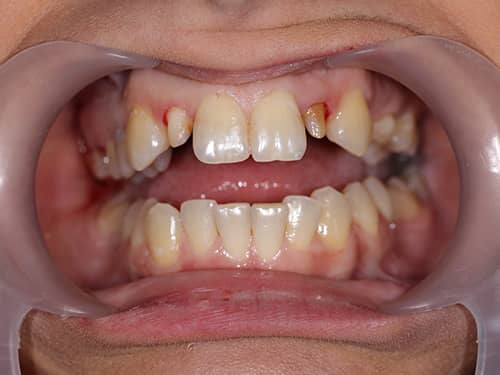 Incisivi laterali pregătiți pentru a fi îmbrăcați cu coroane